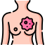 Breast Cancer treatment